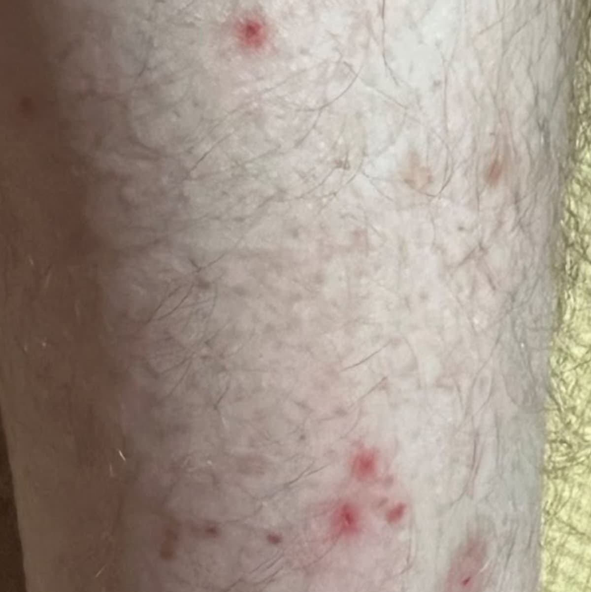 Piqûres de puce sur un tibia