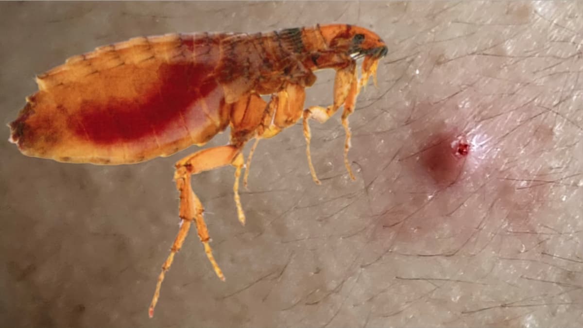 Puce et sa piqure en bouton